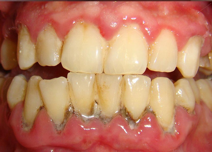 Gingivitis