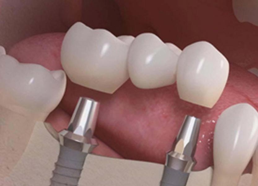 Definition of dental implants